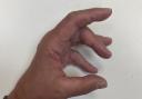 Alan is affected by Dupuytren’s Contracture