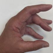 Alan is affected by Dupuytren’s Contracture