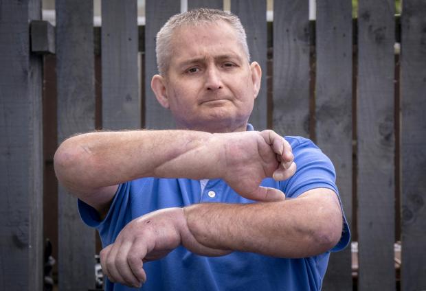 Ardrossan and Saltcoats Herald: Steven is hoping to now return to some kind of work thanks to the operation (PA)