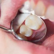 Having good oral health is the simplest way to prevent tooth decay